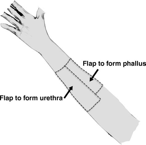 Postoperative Imaging Of Phalloplasties And Their Complications Ajr