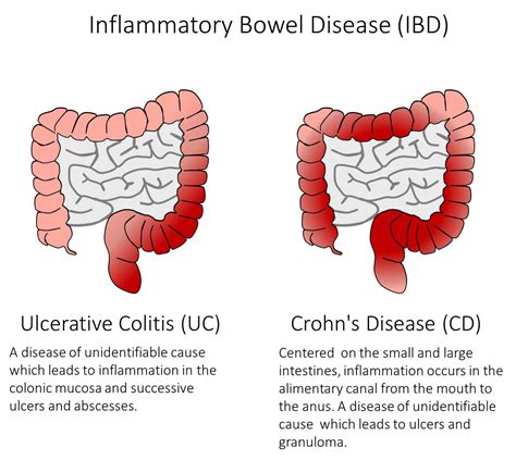 Inflammatory Bowel Disease Treatment