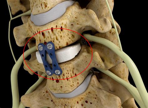 Cervical Discectomy And Fusion