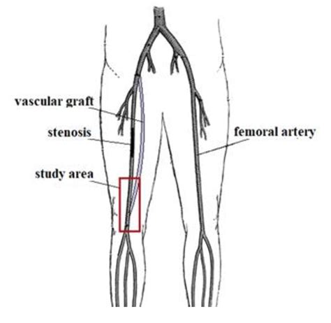 Scheme Of The Graft And Superficial Femoral Artery Junction Download