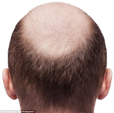 Bald Now Theres A Jab To Make Hair Grow Back Daily Mail Online