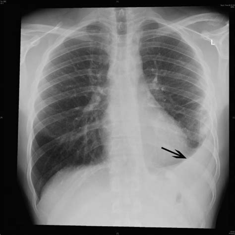 Chest X Ray Showing Left Basal Pneumonia With Para Pneumonic Effusion