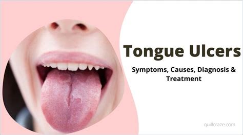 what is tongue ulcers causes symptoms treatment quillcraze
