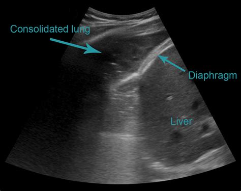 Basic Lung Ultrasound Animal Ultrasound Association