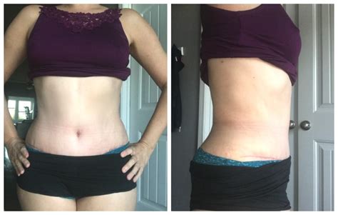 Tummy Tuck Swelling Pictures Before And After Pictures And Experience
