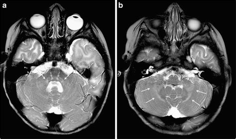 Axial T2 Weighted Images Show Bilateral Middle Cerebellar Peduncle