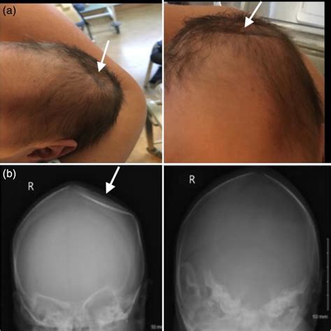 Pdf Congenital Depression Of The Neonatal Skull A Benign Self