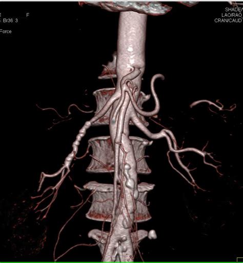 Fibromuscular Dysplasia Fmd Of The Right Renal Artery Vascular Case