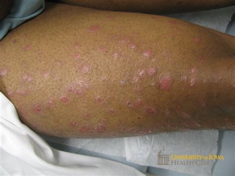 Salmon Colored Papules And Plaques With Scale On The Lower Legs Click