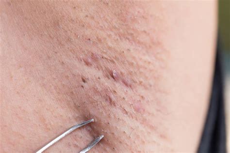 Cysts On Armpit Images Galleries With A Bite