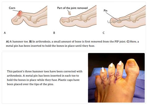 Claw And Hammertoes Treatment In Pune Dr Chetan Oswal