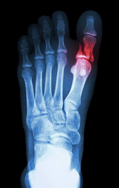 Broken Toe Stock Photos Pictures And Royalty Free Images Istock