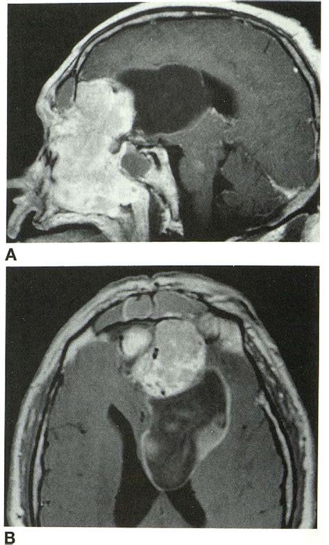 Figure 1 From Sinonasal Esthesioneuroblastoma With Intracranial