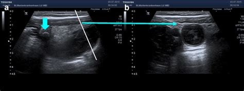 Classification Of Acute Appendicitis Caa Type 2a On Ultrasound