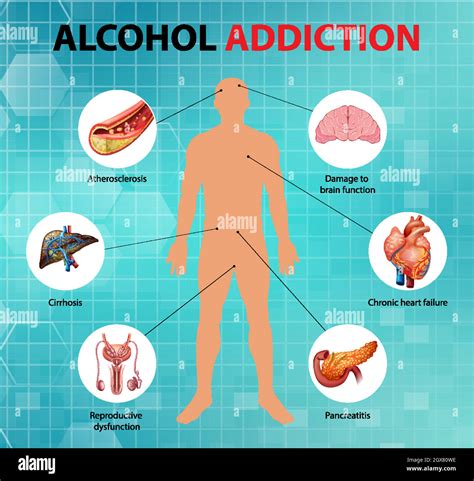 Alcohol Addiction Or Alcoholism Information Infographic Stock Vector