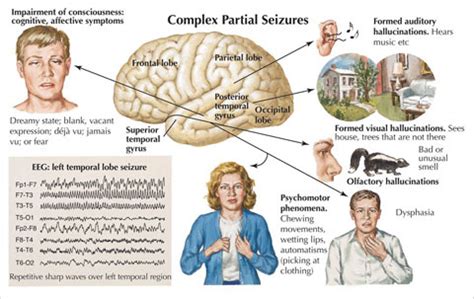 Some common triggers include tiredness and lack of. .Medical Academy: Epilepsy