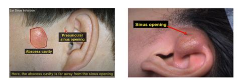 Preauricular Cyst Excision