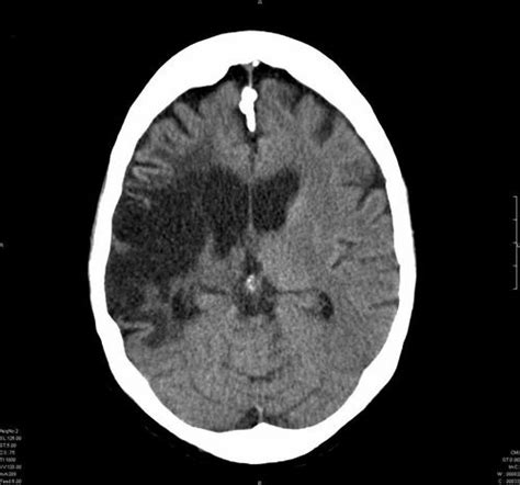 A hemorrhagic stroke occurs when a weakened blood vessel ruptures. medical images: Old right middle cerebral artery stroke