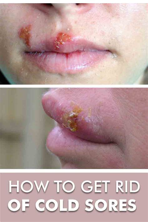 How To Get Rid Of Cold Sores Fast Top 8 Home Remedies For