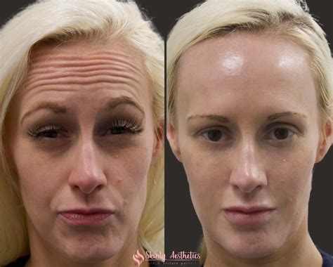Botox Before And After Results Everything You Need To See And Know