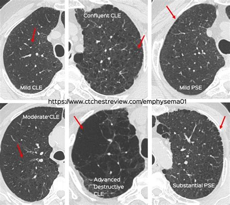 Emphysema Ct Chest Review