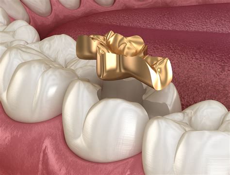 Inlays And Onlays In London Smile Clinic London