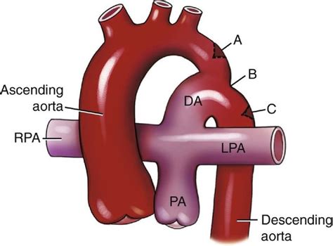 Coarctation Of The Aorta Radiology Key