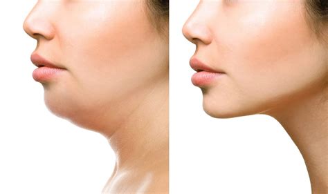 Double Chin Reduction Wolgclinic
