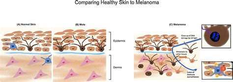 Understanding Melanoma In Kids And Adults · Frontiers For Young Minds
