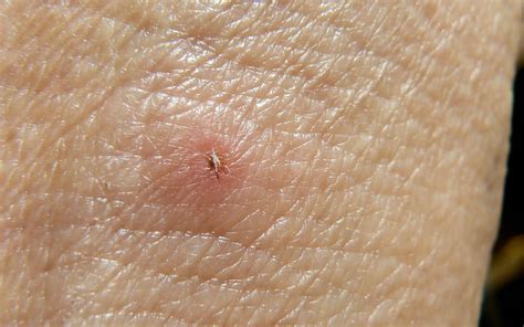 Terrified By Ticks Tick Bites And Lyme Disease Get Empowered With