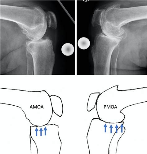 Typical Anteromedial Amoa And Posteromedial Pmoa Osteoarthritis In