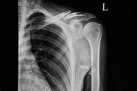 Radiografía De Un Paciente Con Clavícula Fracturada Izquierda Foto