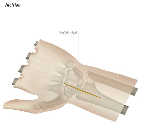 Dorsal Approach To The Wrist Approaches Orthobullets