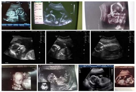 Como Se Mide El Peso Del Bebe En Una Ecografia - Semana 20 de Embarazo (Síntomas, Desarrollo Fetal, Panza y Ecografía)