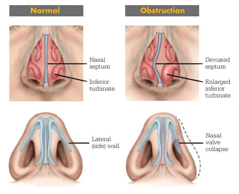 A hound is a type of dog with big floppy ears, mainly used for hunting. Nasal airway obstruction | ENT Stryker