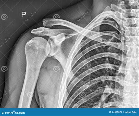 Clavicle Bone Shoulder Medical Xray Stock Photo Image Of Doctor
