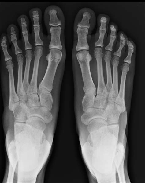 Bipartite Hallux Sesamoid Image