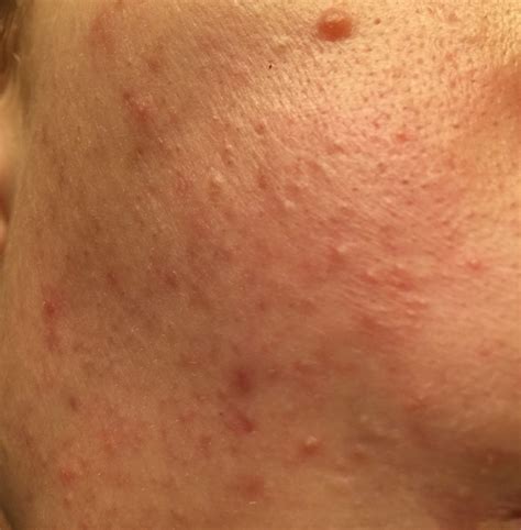 You can spot fungal acne (ahem, malassezia folliculitis) by its itchy, red papules or pustules that are about 1 to 2 millimeters in size (about the tip of a pencil). Is this fungal, parasite, or acne - General acne ...