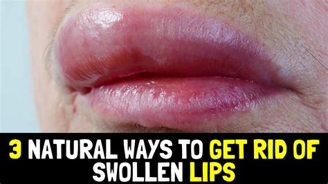 3 Natural And Inexpensive Ways To Get Rid Of Swollen Lips Youtube
