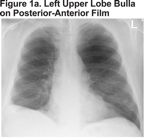 Images In Copd Giant Bullous Emphysema Journal Of Copd Foundation