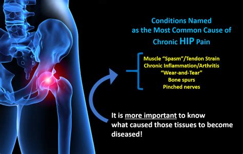 Hip Pain Hyprocure The Proven Solution To Misaligned Feet