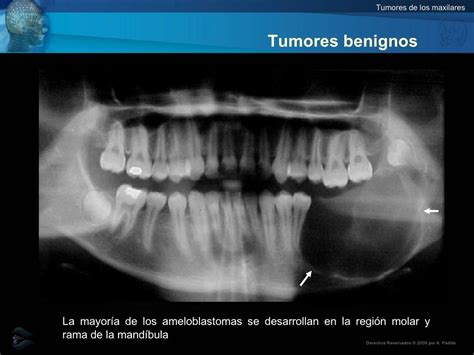 Aspecto Radiografico De Tumores Malignos De Los Maxilares Youtube