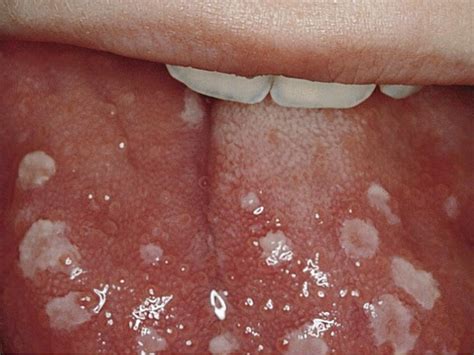 Mouth Lesions Under Tongue