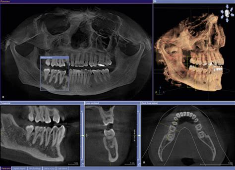 3d Ct It Is Digital Ai Assisted Dental And Jaws X Ray Examination