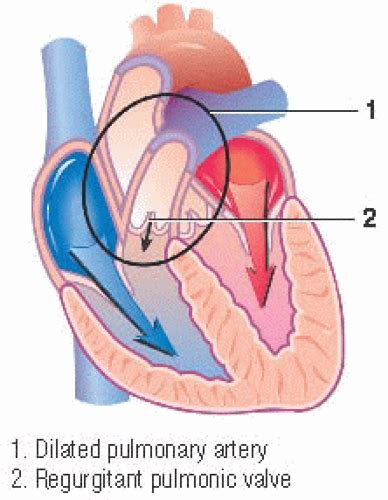 Diastolic Murmurs Thoracic Key