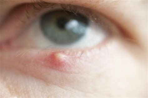 Eye Stye Causes Symptoms Treatment Pictures Stye Eye Stye In