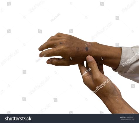 Wound Scab On Human Skin Stock Photo 1988222327 Shutterstock