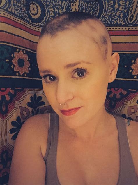 Alopecia Teen Shares Emotional Story Of Hair Loss Thats Forced Her To