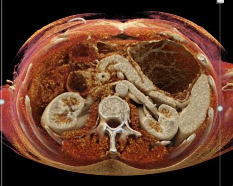 Dilated Pancreatic Duct Seen On Cinematic Rendering Pancreas Case