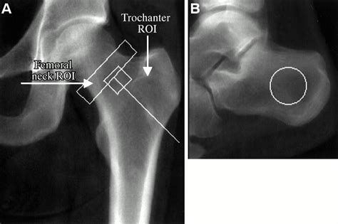 Increased Bone Mineral Content And Bone Size In The Femoral Neck Of Men